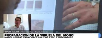 Carlos Álvarez: La viruela del mono sería más fácil de controlar por el periodo de incubación